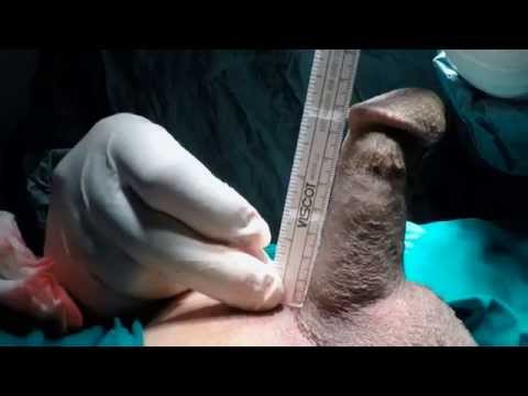 Penile implant surgery via Infrapubic incision - زرع دعامة القضيب في مصر من الفتح الظهري