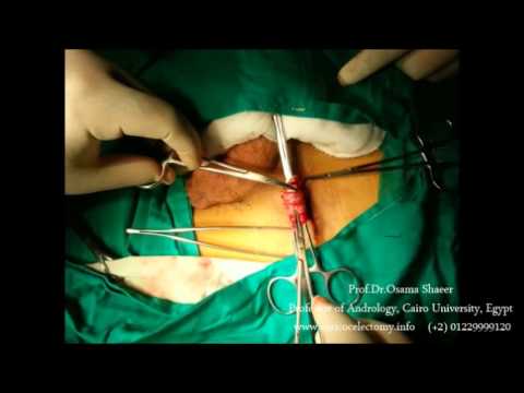 Varicocele surgery, varicocelectomy