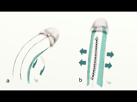 Penile Curvature Surgery Without Shortening: #Corporal_Rotation. #penile_curvature #penile_deviation