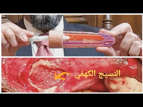 المحافظة علي النسيج الكهفى (النسيج الوظيفى) مع زرع دعامة العضو الذكرى