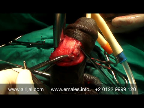 جراحة دعامة العضو الذكرى Penile Prosthesis Surgery in Egypt Up&amp;Close