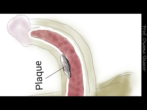 Penile Curvature: Correction of #Peyronie&#039;s. #penile_curvature #penile_deviation #curved_penis