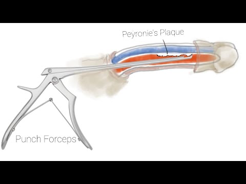 Shaeer&#039;s Peyronie&#039;s Punch Technique for Cases of #Peyronie&#039;s_Disease and ED. #penile_curvature