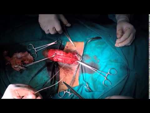 Penile Curvature Surgery In Egypt Without Shortening, Prof. Osama Shaeer