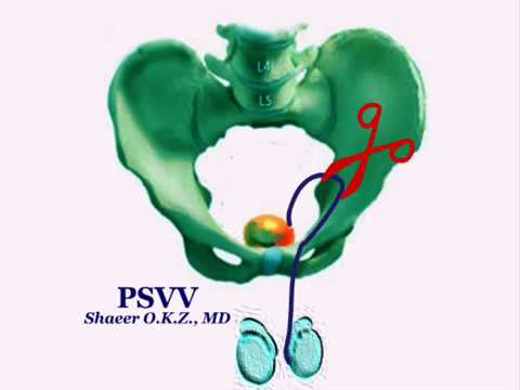 Surgical Treatment of Male Infertility: PSVV