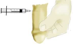 Intracavernous injection ICI is a form of therapy for the treatment of ED