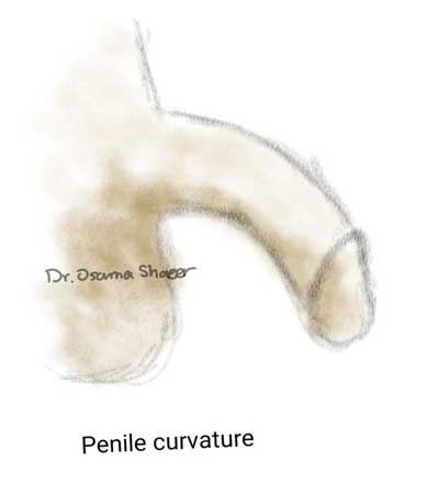 PENILE CURVATURE