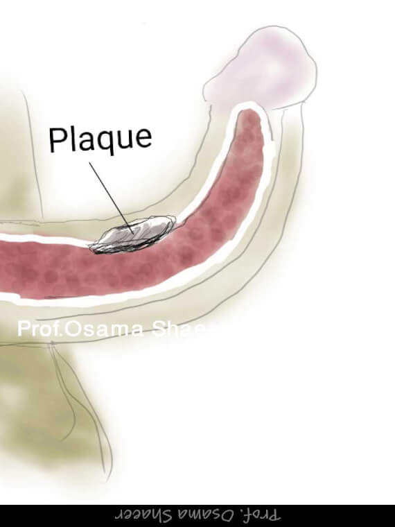 Acquired Penile Curvature Peyronie s Disease